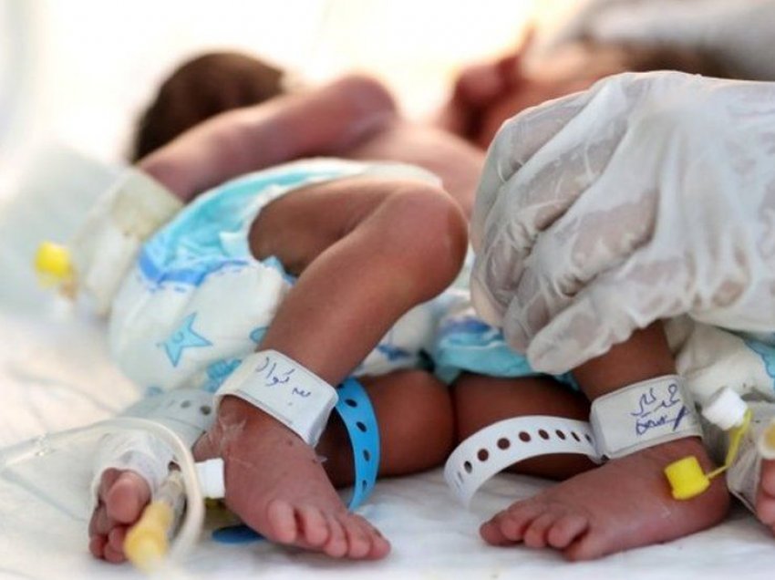 Lindin binjakët siamezë në Jemen, mjekët kërkojnë ndihmë urgjente për operimin e tyre