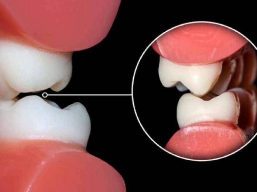 Ja çka sugjerojnë dentistët për personat që kërcasin dhëmbët në gjumë