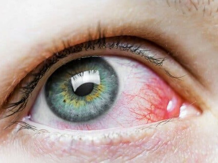 Njollat e kuqe në sy; Pse shkaktohen dhe a janë të rrezikshme