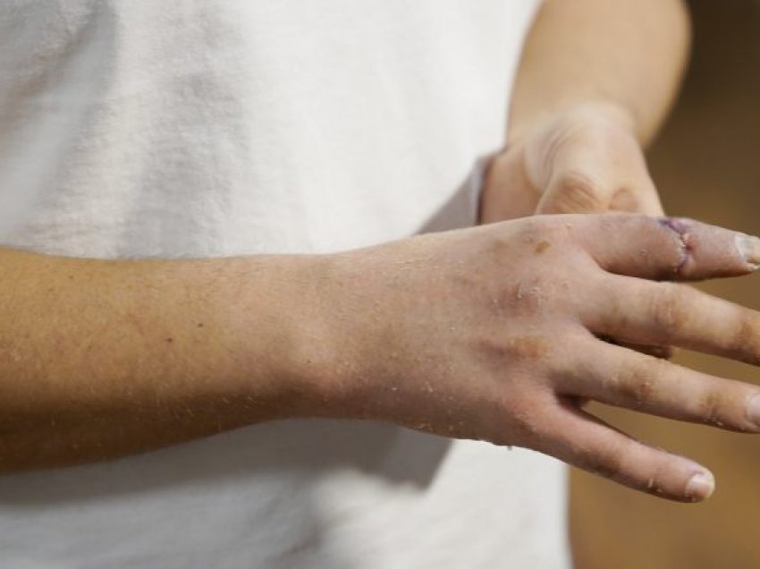 Kirurgu turk “ia kthen gishtin e dorës në vend” pacientit të tij, 19 orë pasi ai e kishte “këputur”