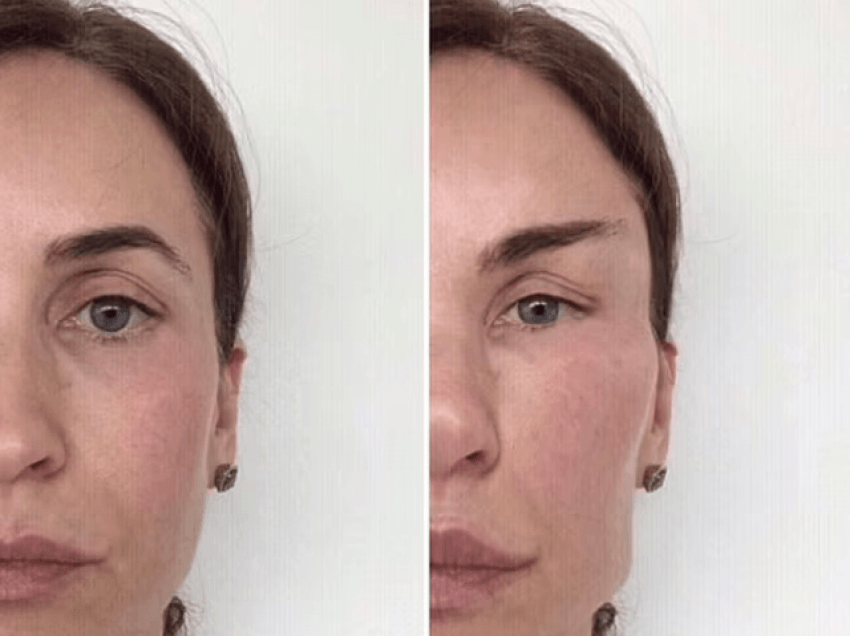 Kirurgu kozmetik tregon si pacientet po 'shtrembërohen' pasi ndjekin standardet joreale të bukurisë në Instagram