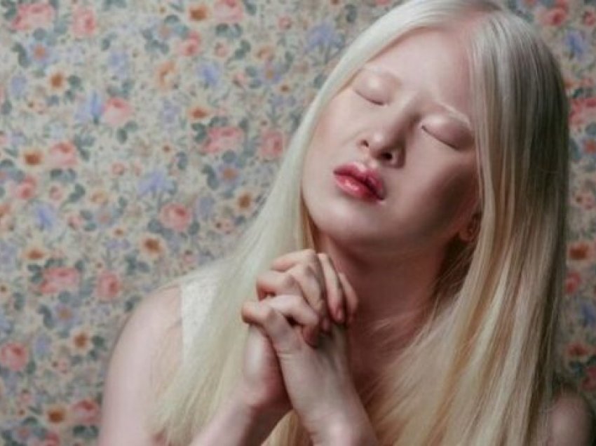 Sot është modele e Vogue, vajza që e braktisën prindërit pse ishte albine