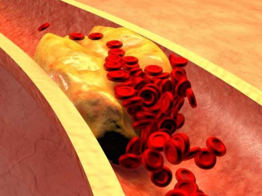 5 shenja që mund të tregojnë se keni kolesterol të lartë