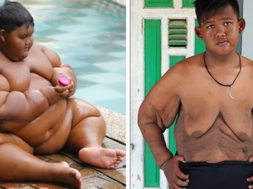 Djali që dikur ishte më i shëndoshë në botë tregon trupin e tonifikuar pasi humbet 100 kg