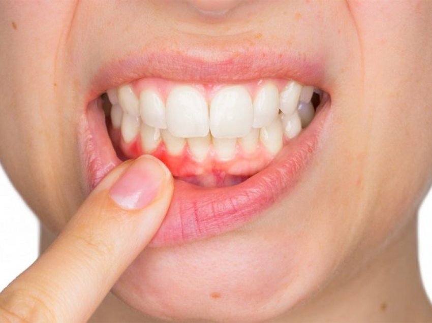 Sëmundja që shkakton rënien e dhëmbëve – Çfarë duhet të bëni
