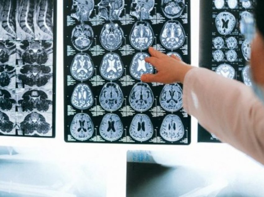 A mundet të identifikojë njerëzit Inteligjenca Artificiale që rrezikojnë të preken nga Alzheimer?