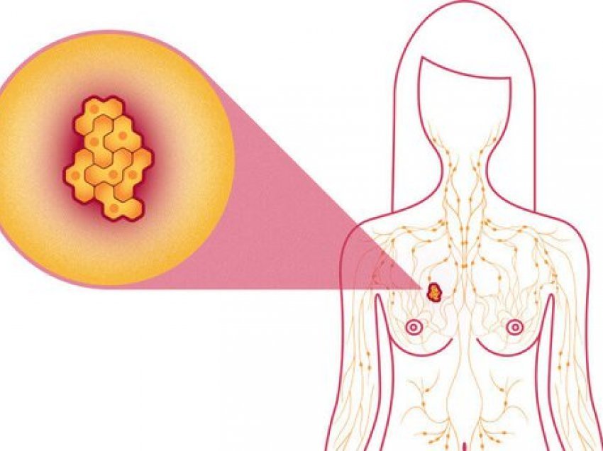 4 shenjat e pabesueshme të kancerit të gjirit që s'kanë lidhje fare me dhimbjet apo zonën e kraharorit