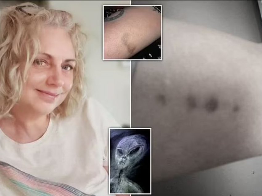 Gjyshja pretendon se është “rrëmbyer” 52 herë nga alienët, zbulon imazhet me shenjat që i kanë lënë në trup