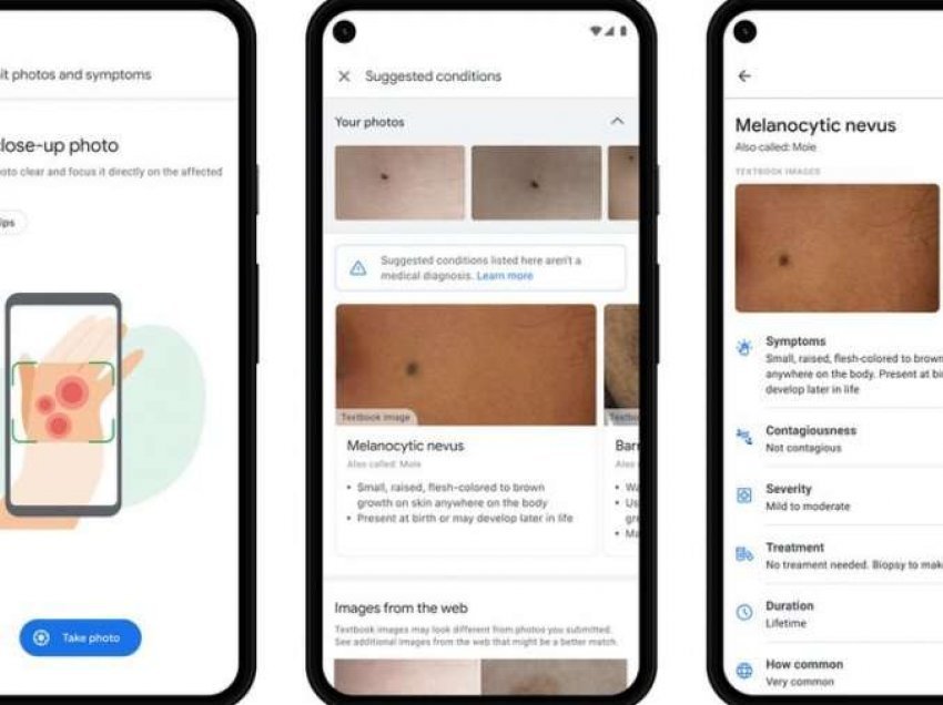 Google prezanton një aplikacion që ndihmon pacientët të identifikojnë problemet në lëkurë