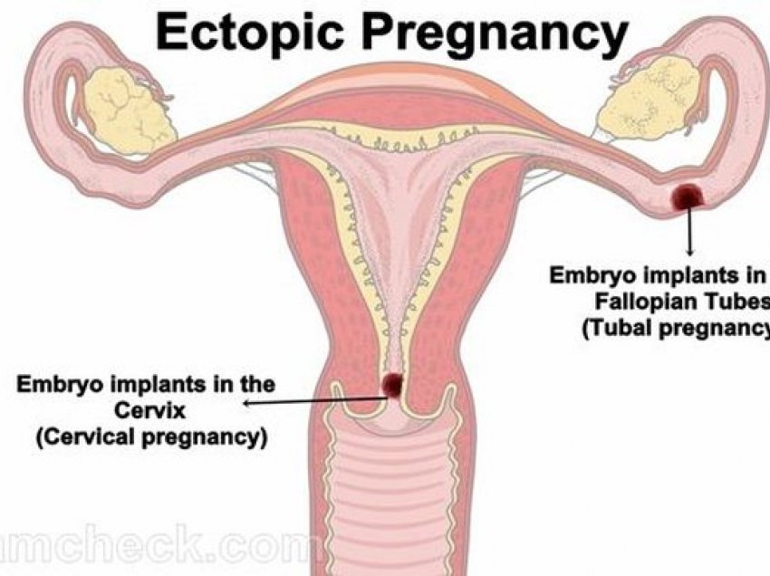 Simptomat e para të një shtatzënie jashtë mitre