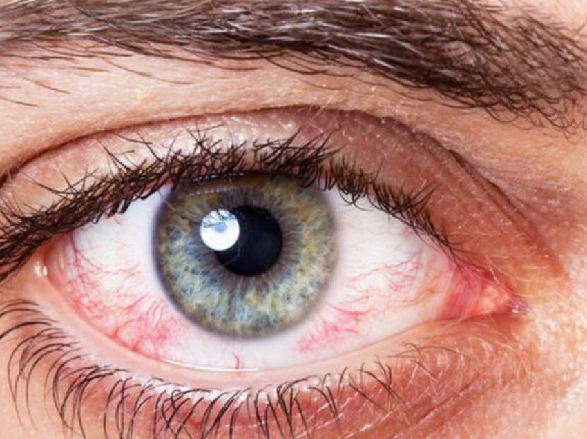 Stresi i vazhdueshëm dëmton sytë
