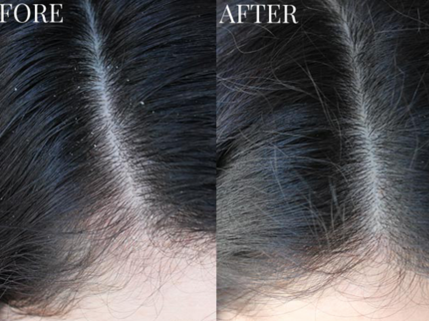 Zhdukni zbokthin nga flokët me 5 metoda natyrale