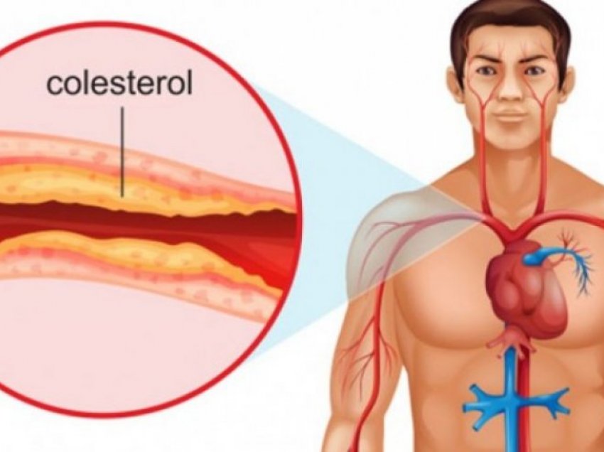 Mund të shpëtojë 30 mijë jetë ilaçi i ri për uljen e kolesterolit