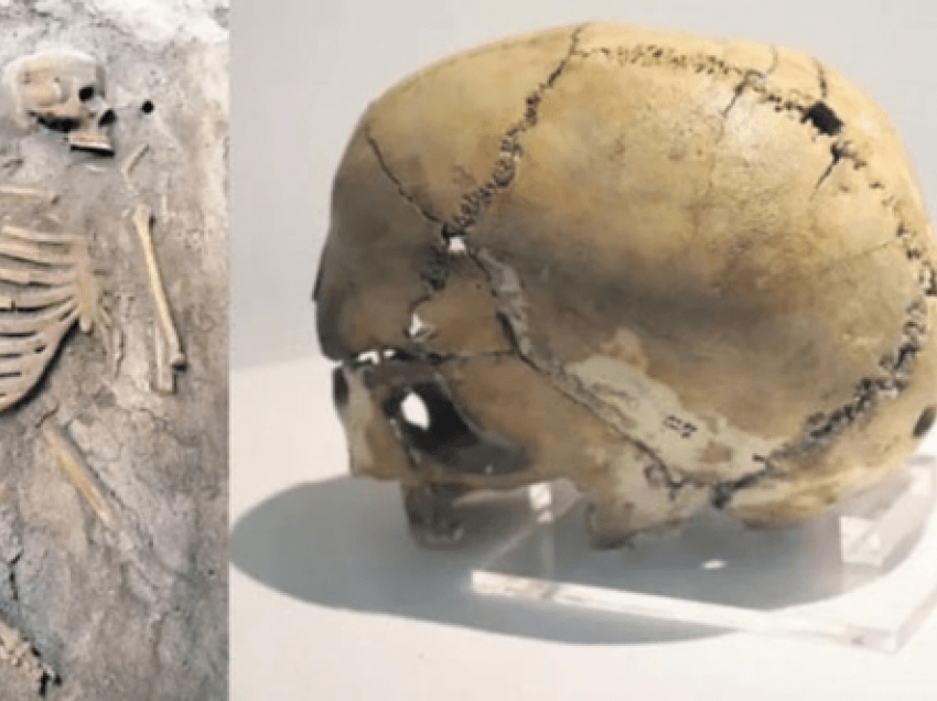Operacioni në  kokën e një të reja, para 9500 vitesh