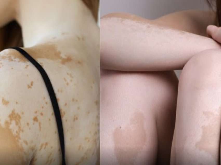 ​Vitiligo - një sëmundje e lëkurës që shkakton humbje të pigmentit