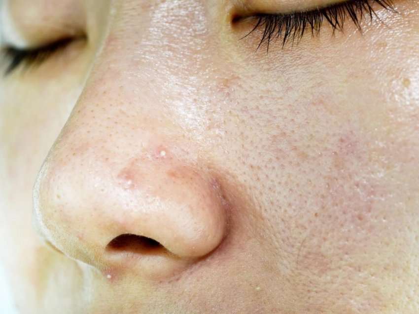 Lëkurë yndyrore, në fytyrë dhe në trup: Shkaqet, simptomat dhe kujdeset