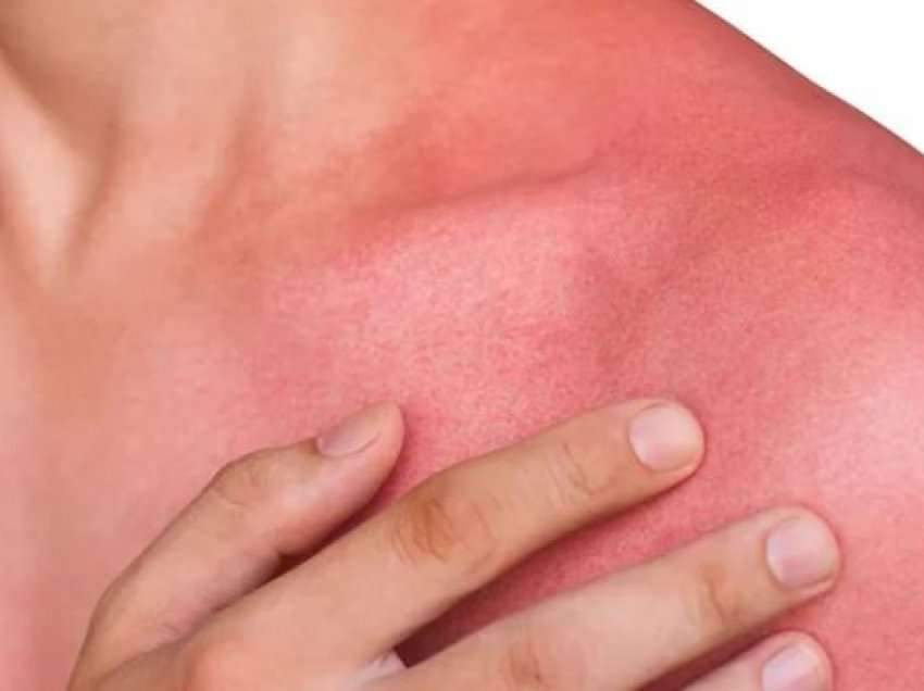 Këto simptoma ju tregojnë se jeni alergjik nga dielli, kush rrezikohet më shumë dhe si të mbroheni
