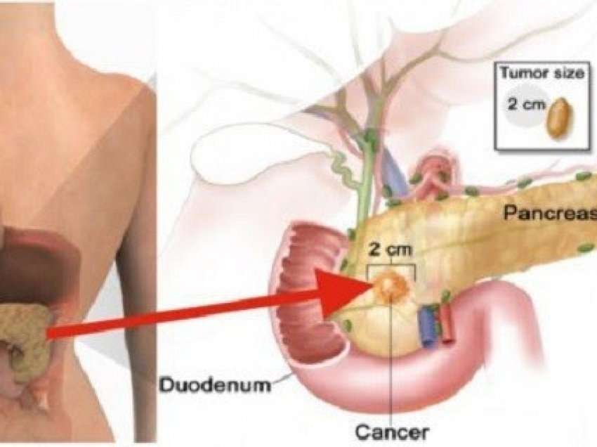 ​Çfarë janë tumoret neuroendokrine të pankreasit
