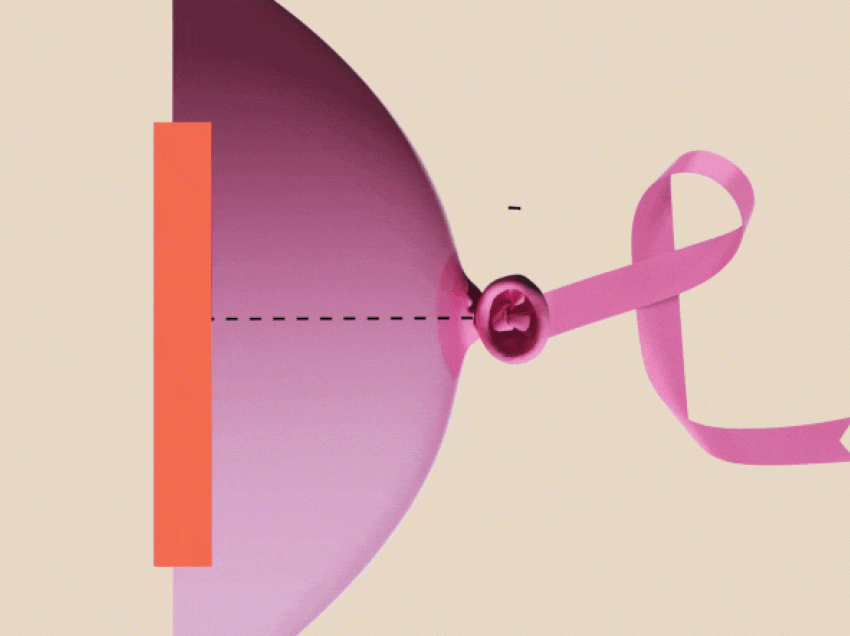 Faza 0 e kancerit të gjirit: Faktorët e rrezikut dhe parandalimi