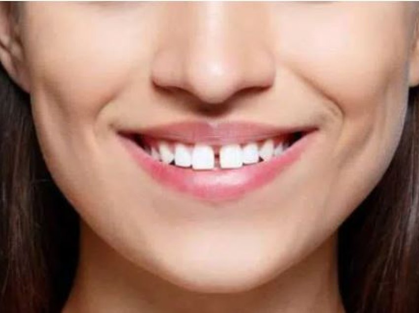E dini se çka do të thotë nëse i keni dhëmbët e parë të larguar nga njëri-tjetri?