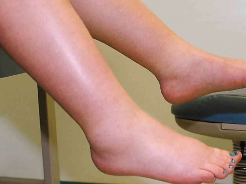 Këta janë shkaktarët më të shpeshtë të fryrjes së këmbëve