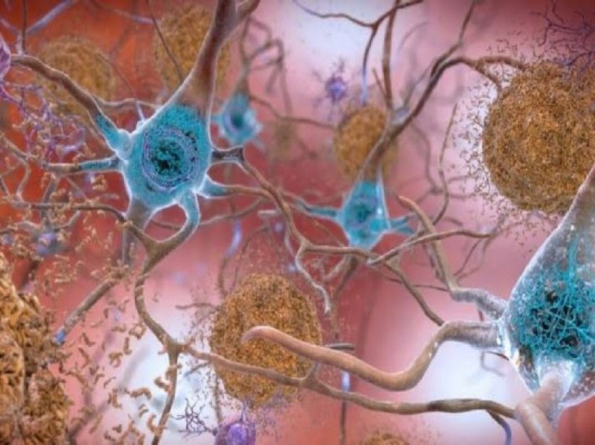 ​Studimi i ri tregon lidhjen midis sasisë së proteinave amiloide me sëmundjen e Alzheimerit