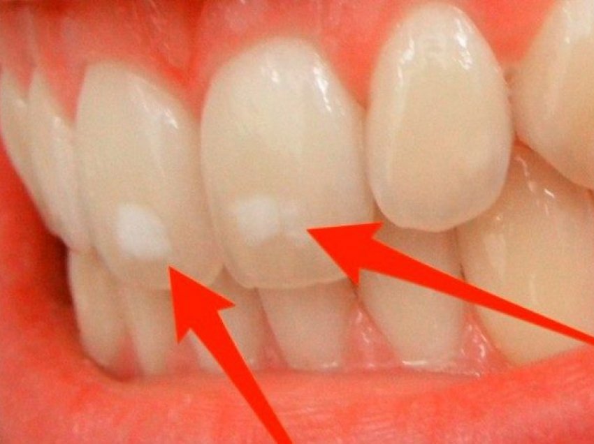 Nëse keni njolla të bardha në dhëmbë, patjetër duhet të dini këtë gjë