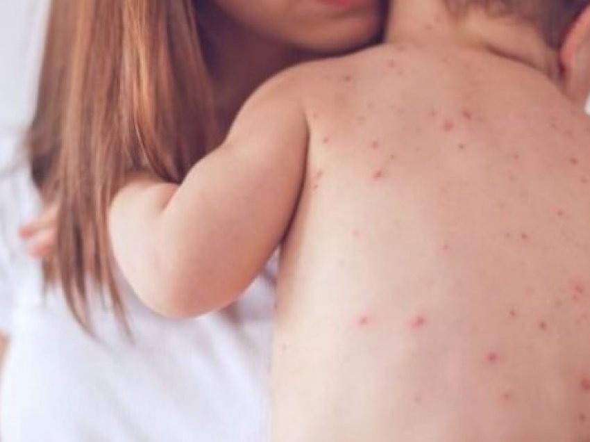 Spirovski: Mos-vaksinimi kundër fruthit, rrezikon shëndetin e fëmijëve