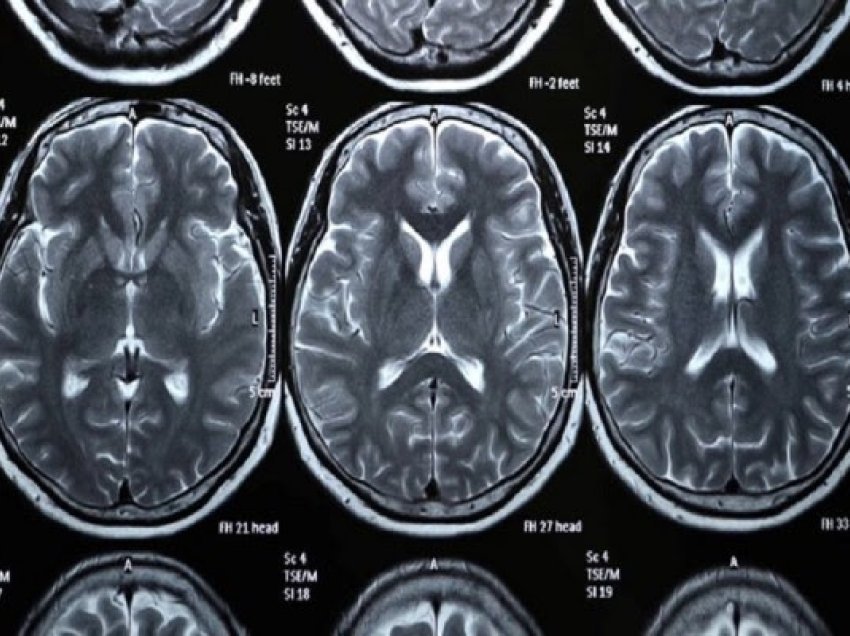 ​Gjenden sinjale të çuditshme në lëndën e bardhë të trurit: Nuk e dimë çfarë, por diçka po ndodh atje