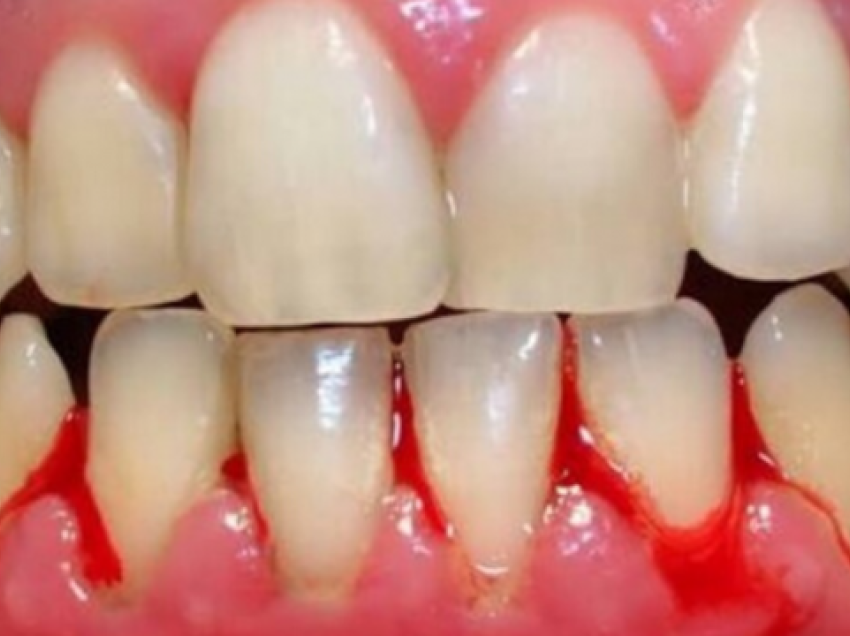 Gjakderdhje te mishrat e dhëmbëve? Keni mungesë të kësaj vitamine