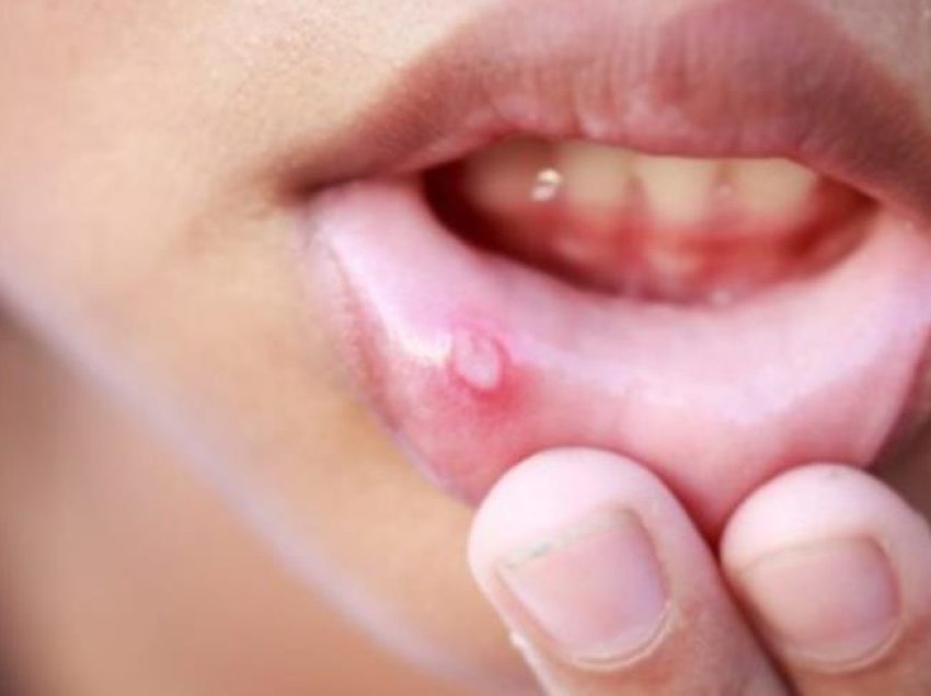 Metodat që shërojnë pezmatimin e gojës
