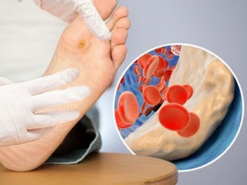 ​Kolesteroli i lartë: Tri shenja në këmbë që kërkojnë kujdes të menjëhershëm mjekësor
